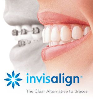 Invisalign® First - Mint Orthodontics